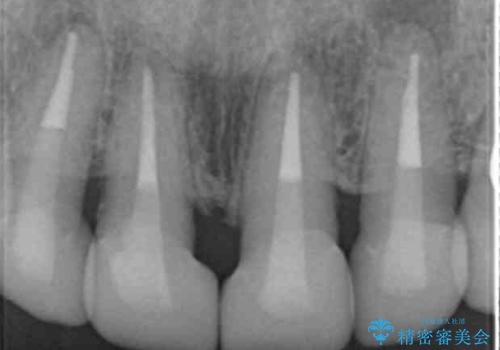 長持ちするセラミック 4年半経過症例 50代女性の治療中