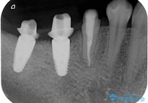 奥歯が割れている 抜歯してインプラントへ 40代女性の治療中