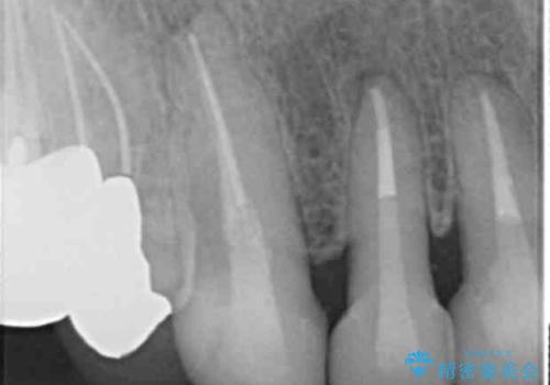 長持ちするセラミック 4年半経過症例 50代女性の治療中