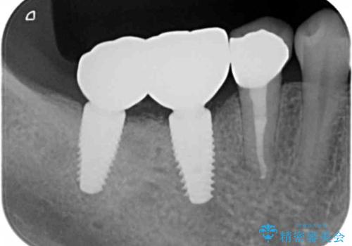 奥歯が割れている 抜歯してインプラントへ 40代女性の治療後