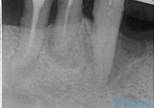 「 歯周病 再生治療 」再生治療で歯を残すの治療前