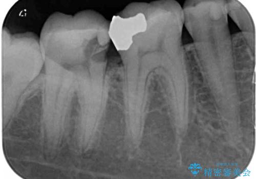 奥歯のむし歯が痛む セラミッククラウンとゴールドインレーによるむし歯治療の治療前