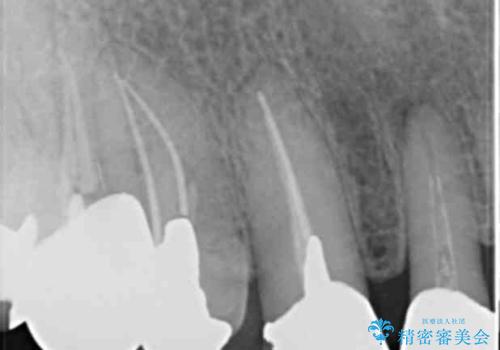 長持ちするセラミック 4年半経過症例 50代女性の治療前
