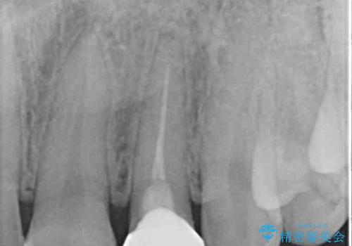 むし歯で変色した前歯をセラミッククラウンできれいにの治療後