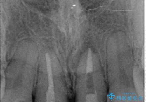 前歯が疼く セラミッククラウンのやり替えの治療中