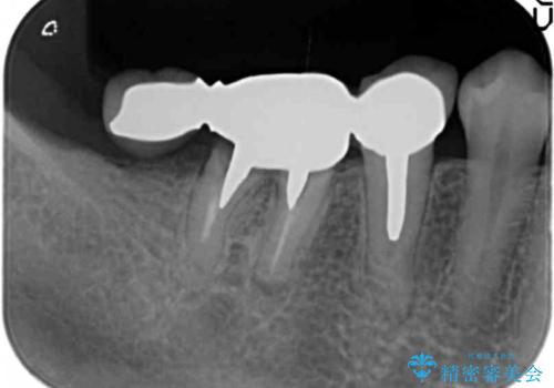 奥歯が割れている 抜歯してインプラントへ 40代女性の治療前