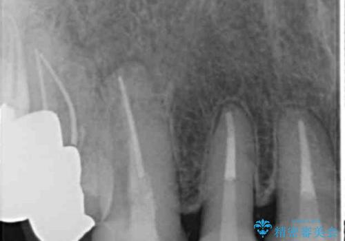 長持ちするセラミック 4年半経過症例 50代女性の治療後