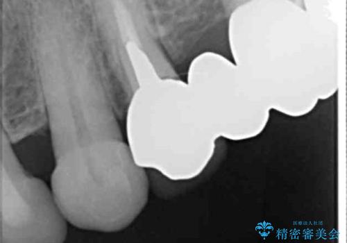 長持ちするセラミック 4年半経過症例 50代女性の治療後