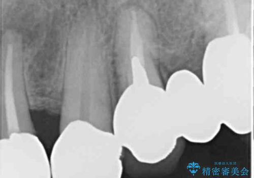 長持ちするセラミック 4年半経過症例 50代女性の治療前