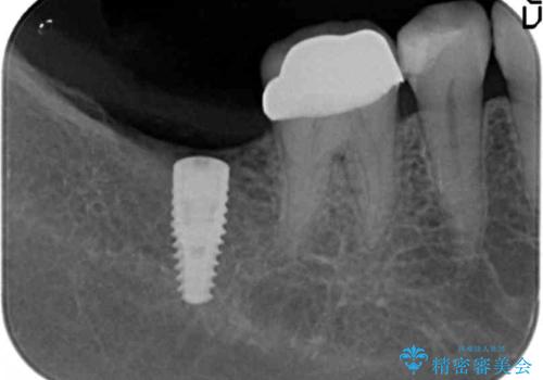 奥歯のインプラント治療の治療中