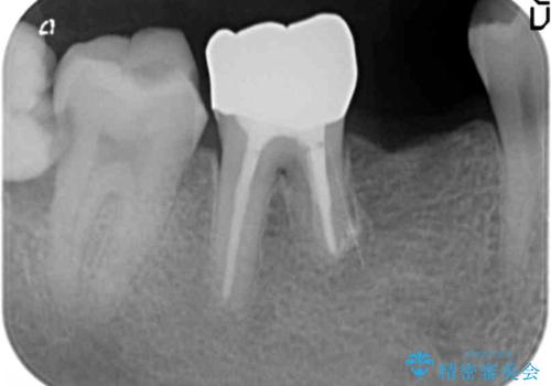 親知らずのせいで隣の歯が虫歯に 40代男性の治療前