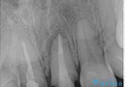 前歯が疼く セラミッククラウンのやり替えの治療中