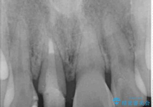 オーダーメイドで造る、自然な前歯セラミッククラウンの治療中