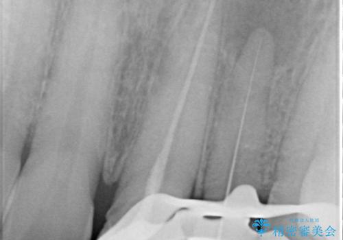 [ 歯が小さい ] 根管治療を伴う矮小歯治療の治療前