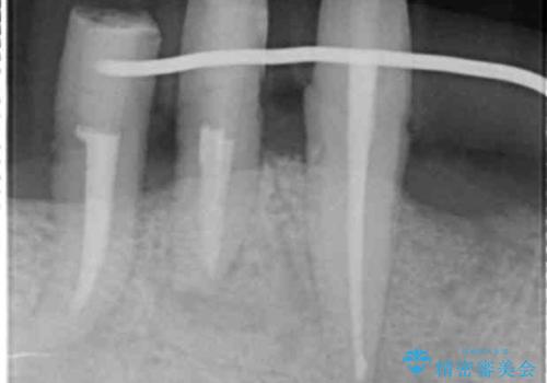 「 歯周病 再生治療 」再生治療で歯を残すの治療中