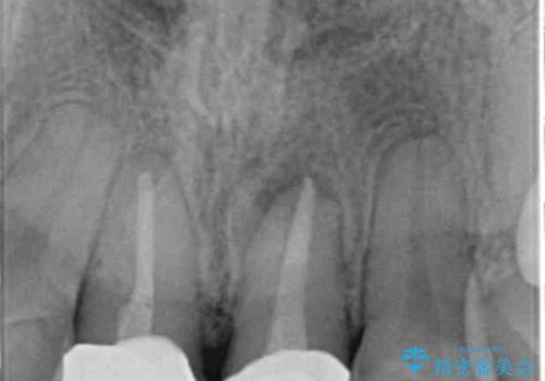 前歯が疼く セラミッククラウンのやり替えの治療後
