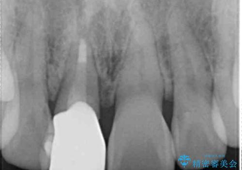 オーダーメイドで造る、自然な前歯セラミッククラウンの治療後