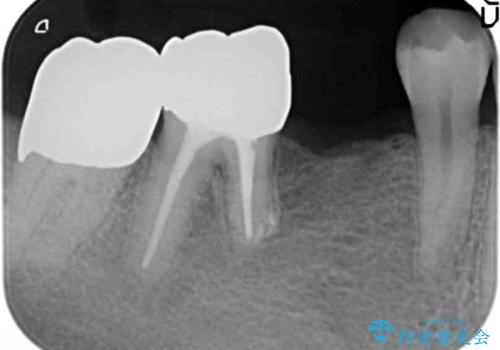 親知らずのせいで隣の歯が虫歯に　40代男性の治療中