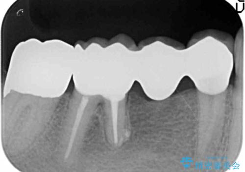 親知らずのせいで隣の歯が虫歯に 40代男性の治療後