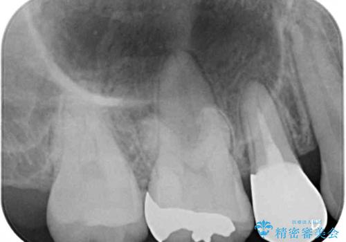 結婚式までに前歯をきれいにしたい 抜歯矯正とオールセラミッククラウンの治療後
