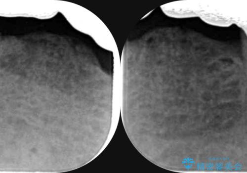 「 歯周病 再生治療 」再生治療で歯を残すの治療後