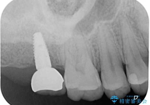 歯に穴を開けられてしまった　インプラントによる奥歯の補綴治療の治療後