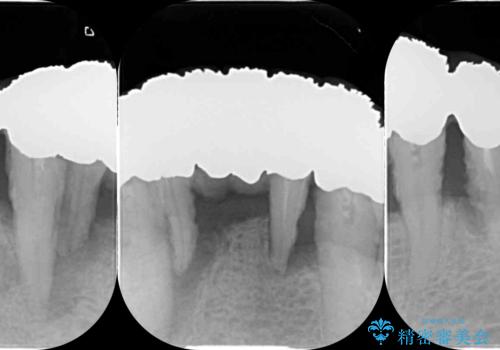 「 歯周病 再生治療 」再生治療で歯を残すの治療前
