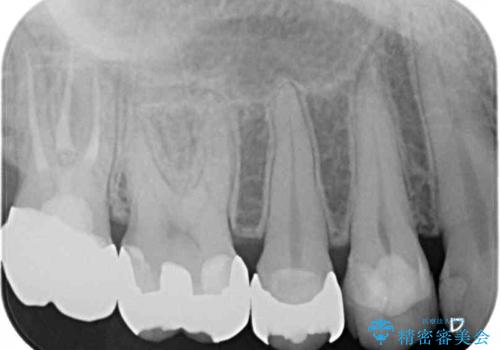 奥歯のむし歯が痛む セラミッククラウンとゴールドインレーによるむし歯治療の治療後
