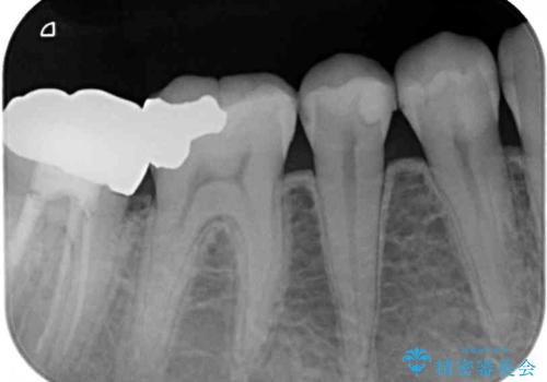 奥歯のむし歯が痛む セラミッククラウンとゴールドインレーによるむし歯治療の治療後