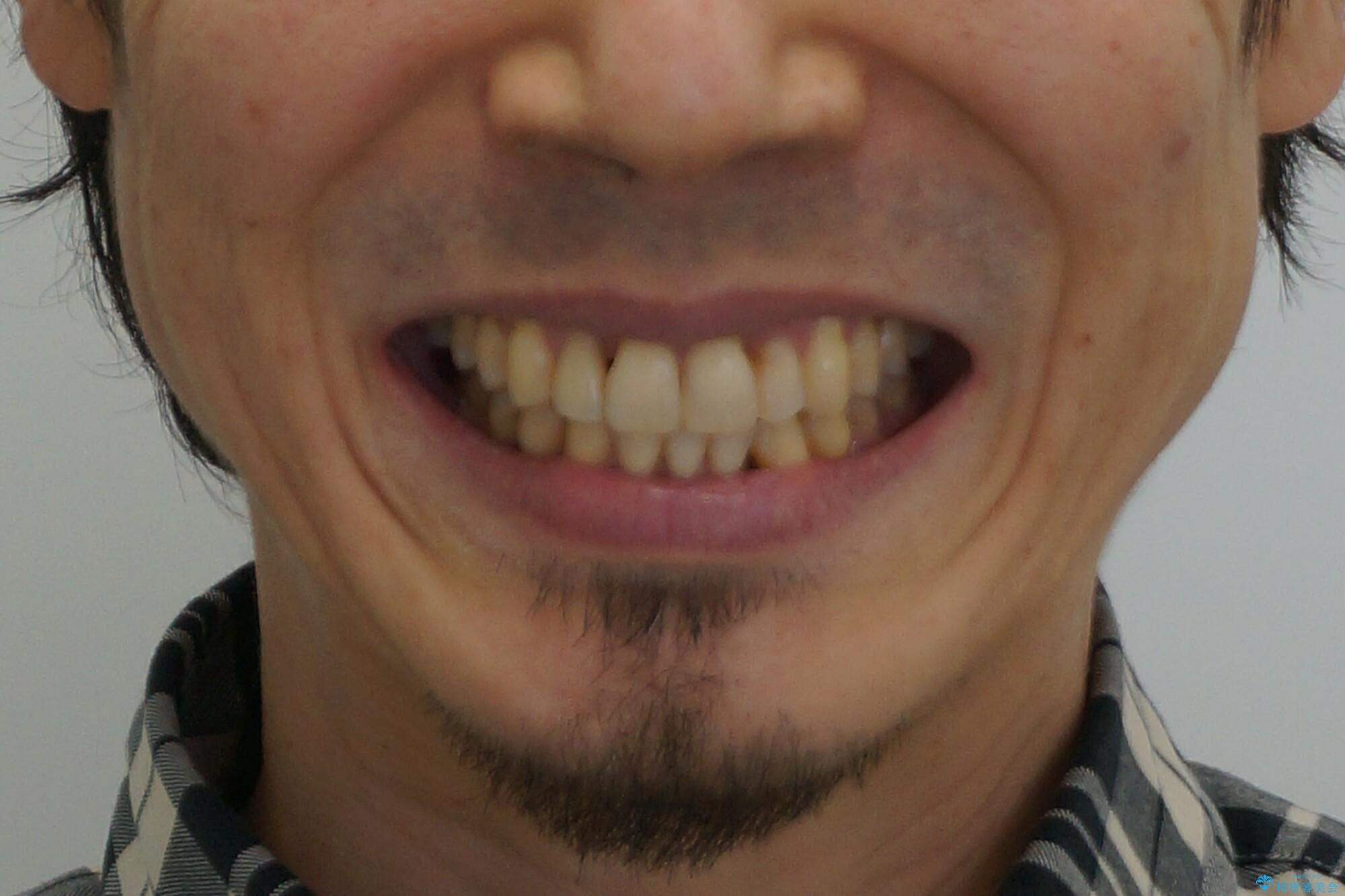 前歯の虫歯 矯正治療してからしっかり治すの治療後(顔貌)