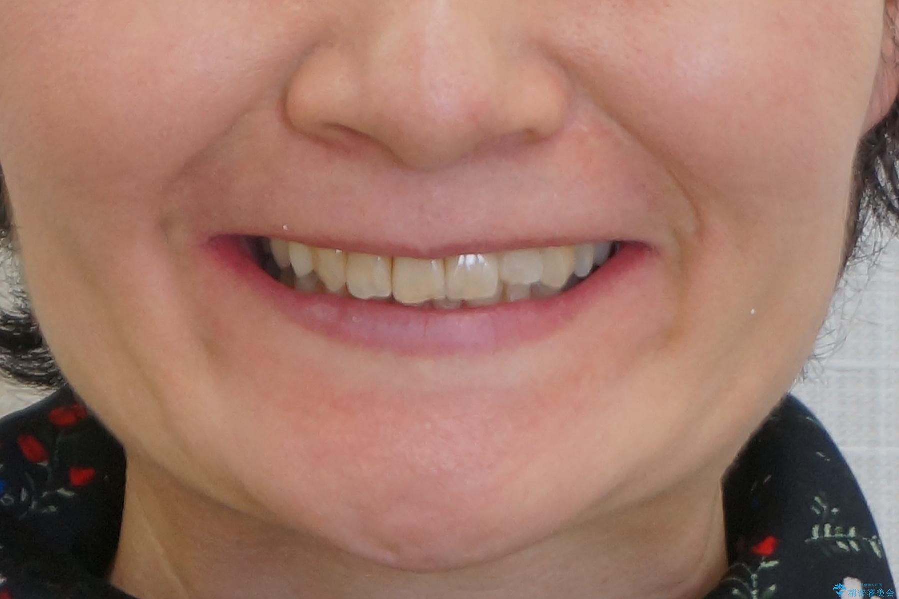 50代女性 インビザライン かみ合わせが深く、難しい症例の治療後(顔貌)