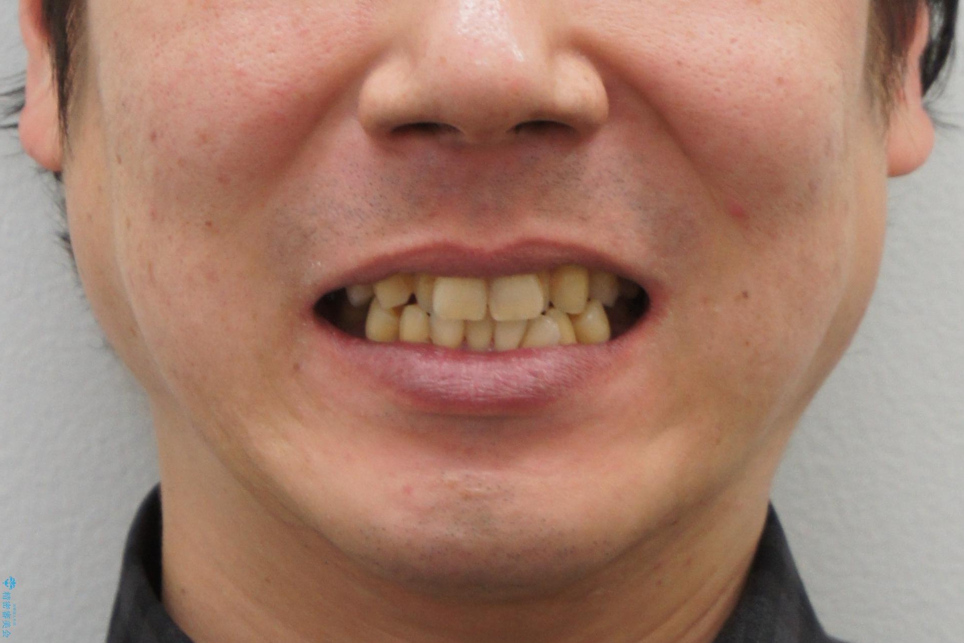 前歯の虫歯 矯正治療してからしっかり治すの治療前(顔貌)