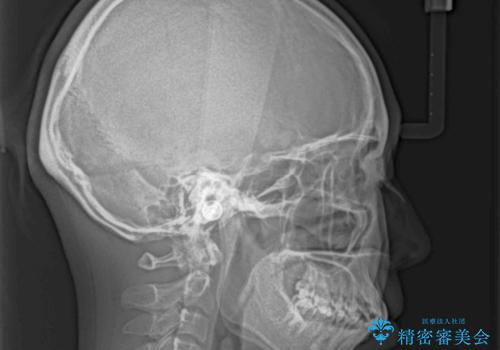ふっくらとした口元を改善したい 目立たないワイヤー装置による抜歯矯正の治療前