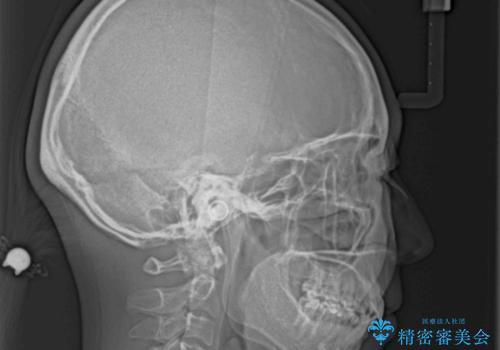 ふっくらとした口元を改善したい 目立たないワイヤー装置による抜歯矯正の治療後