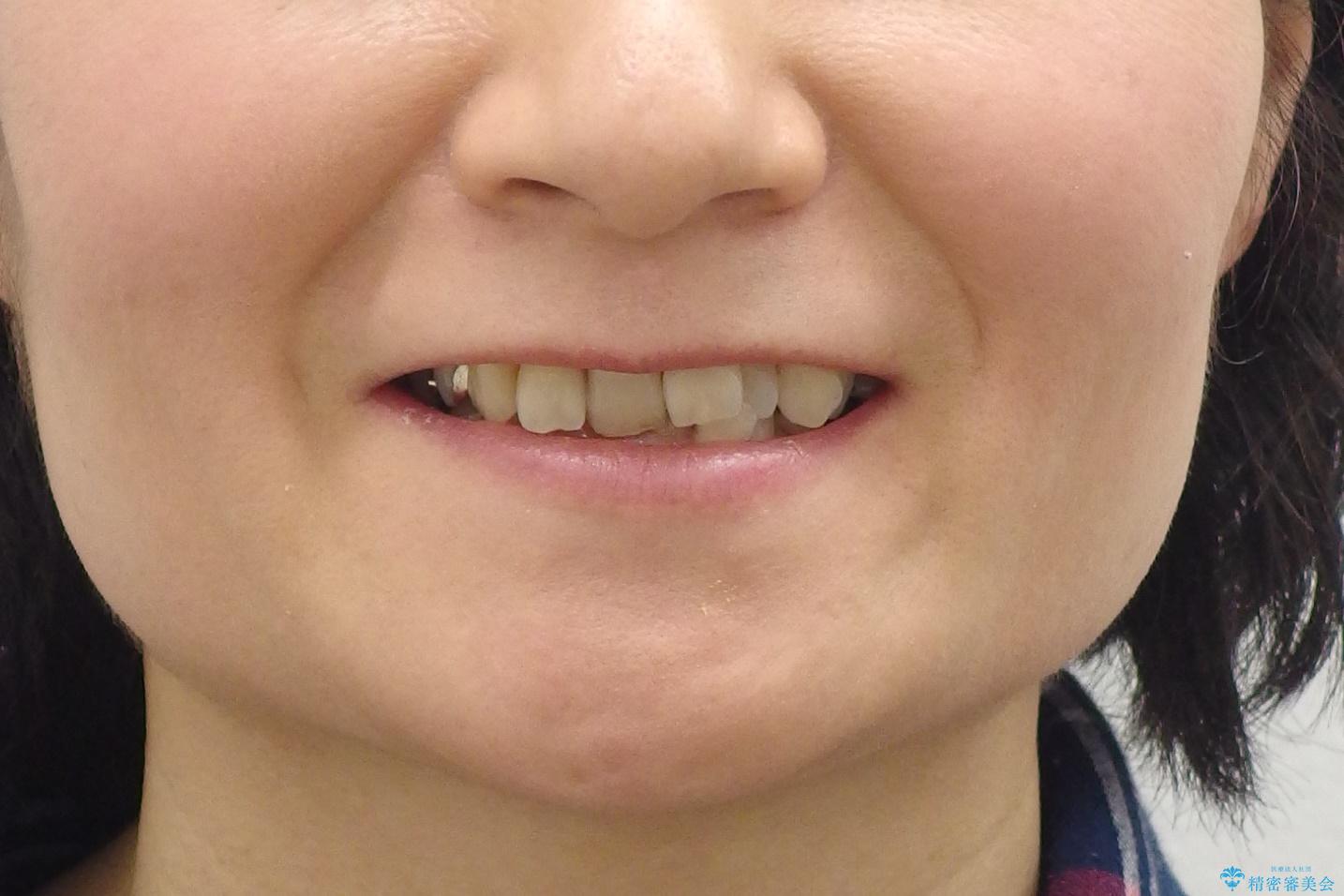 50代女性 インビザライン かみ合わせが深く、難しい症例の治療前(顔貌)