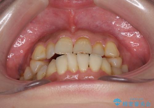 どこで咬んで良いのか分からない インビザラインでの咬み合わせの改善の治療前