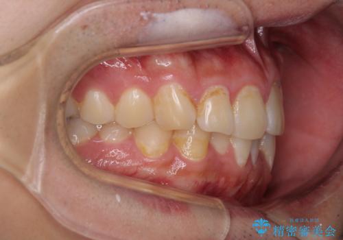 気になる前歯を治したい 短期間でのインビザライン矯正の治療前