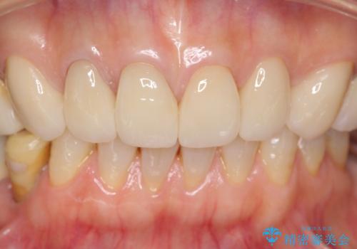 長持ちするセラミック 4年半経過症例 50代女性の治療中