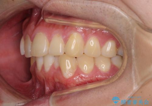 気になる前歯を治したい 短期間でのインビザライン矯正の治療前