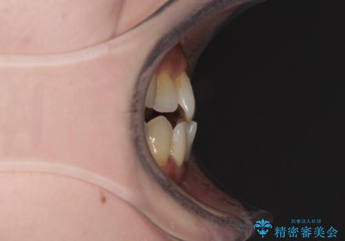 どこで咬んで良いのか分からない インビザラインでの咬み合わせの改善の治療前