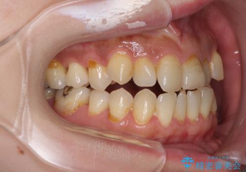 どこで咬んで良いのか分からない インビザラインでの咬み合わせの改善の治療前