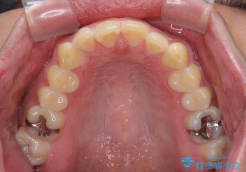 気になる前歯を治したい 短期間でのインビザライン矯正の治療前