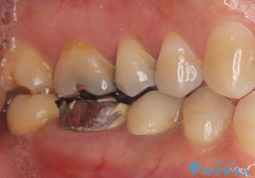 奥歯が割れている 抜歯してインプラントへ 40代女性の治療前