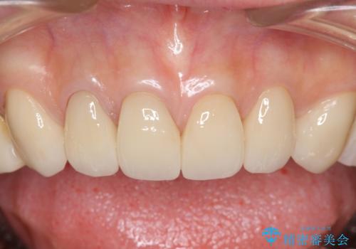 長持ちするセラミック 4年半経過症例 50代女性の治療中