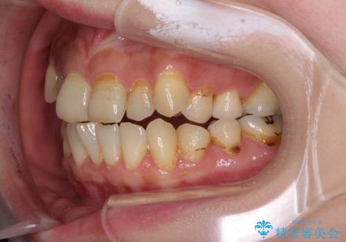 どこで咬んで良いのか分からない インビザラインでの咬み合わせの改善の治療前