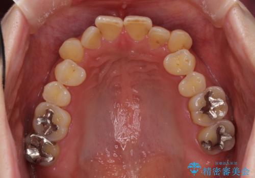 どこで咬んで良いのか分からない インビザラインでの咬み合わせの改善の治療前