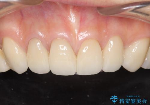 長持ちするセラミック 4年半経過症例 50代女性の治療中