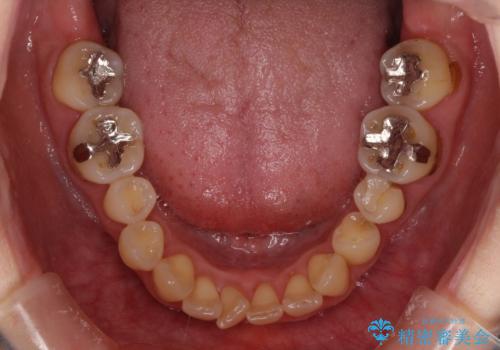 どこで咬んで良いのか分からない インビザラインでの咬み合わせの改善の治療前