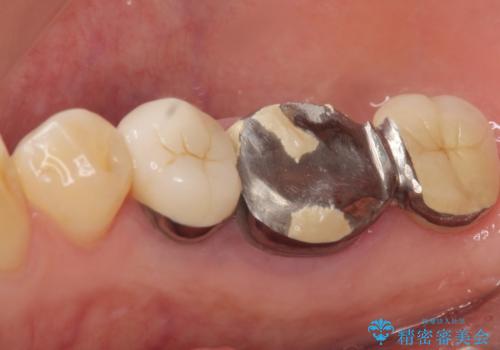 奥歯が割れている 抜歯してインプラントへ 40代女性の治療前