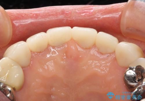 長持ちするセラミック 4年半経過症例 50代女性の治療中